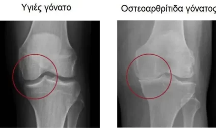 Knee Osteoarthritis