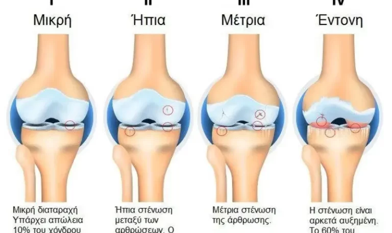 Knee Osteoarthritis Stages