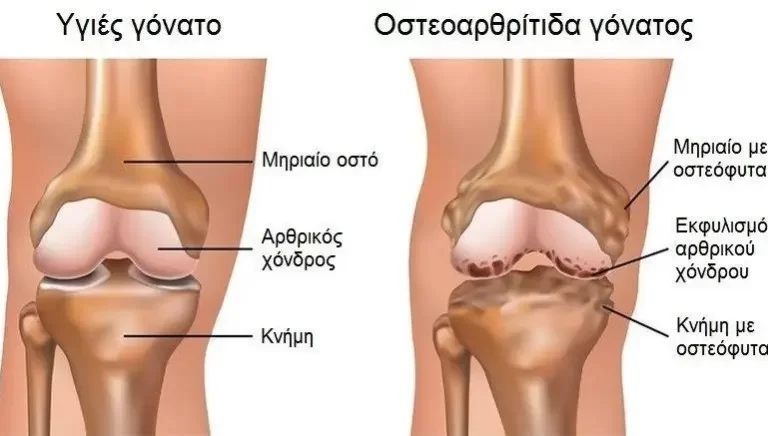 Knee Osteoarthritis- further explained