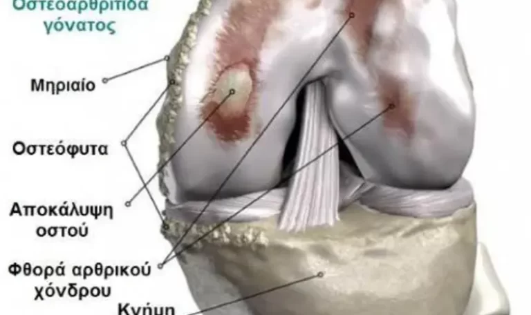 Knee Osteoarthritis: Explanation and relevance